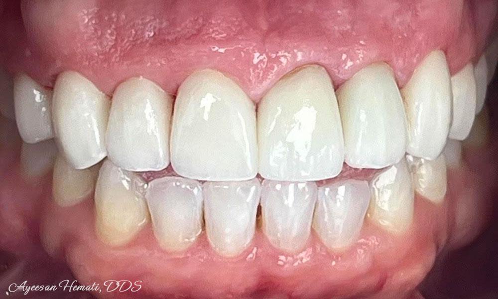 After Treatment