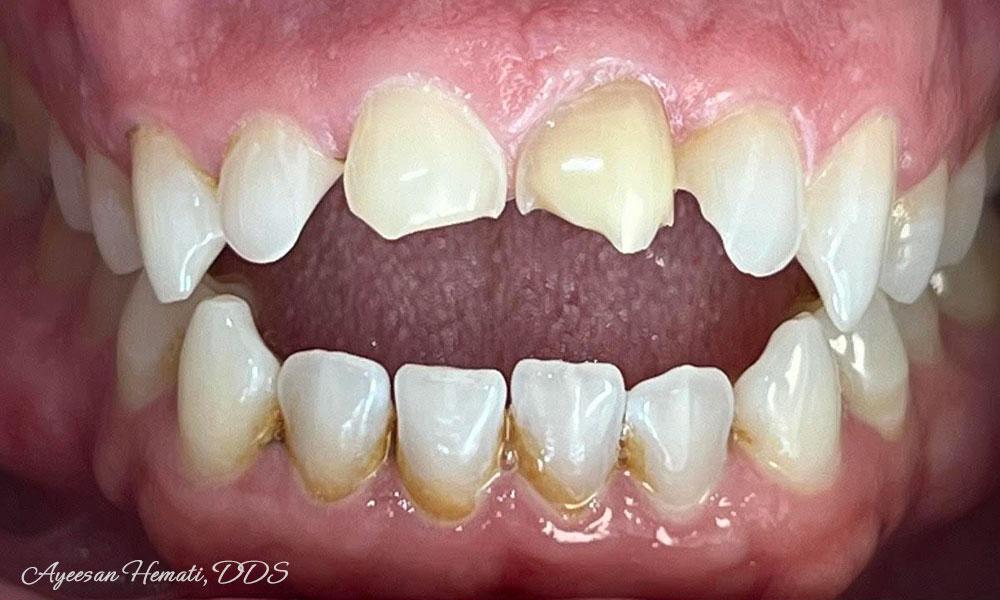 Before Treatment