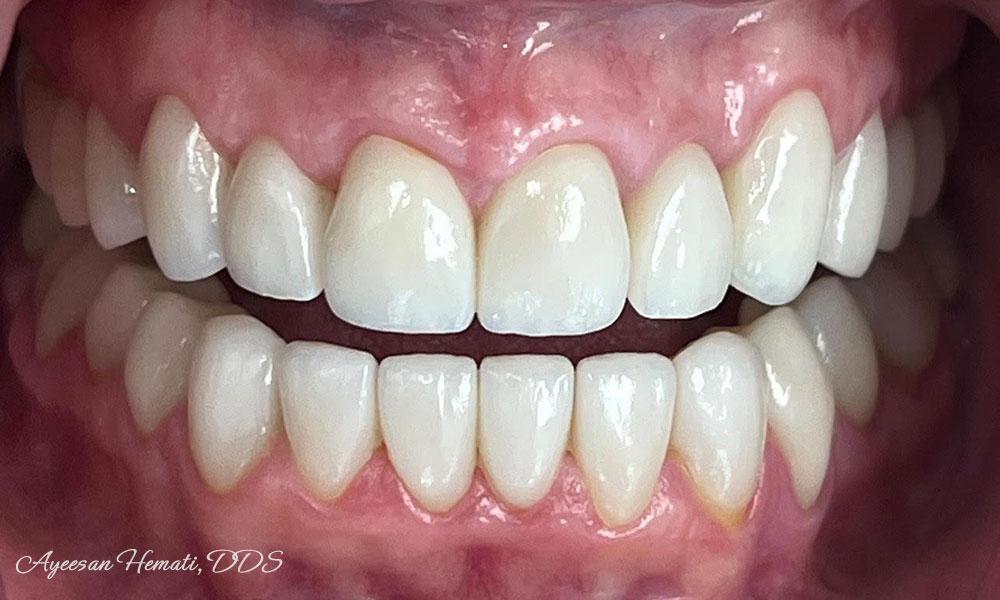 After Treatment