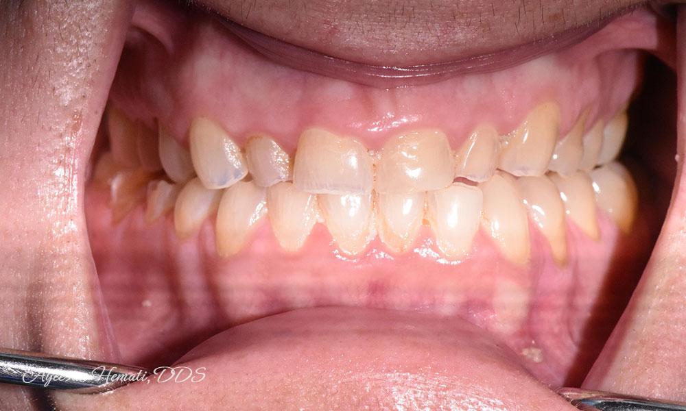 Before Treatment